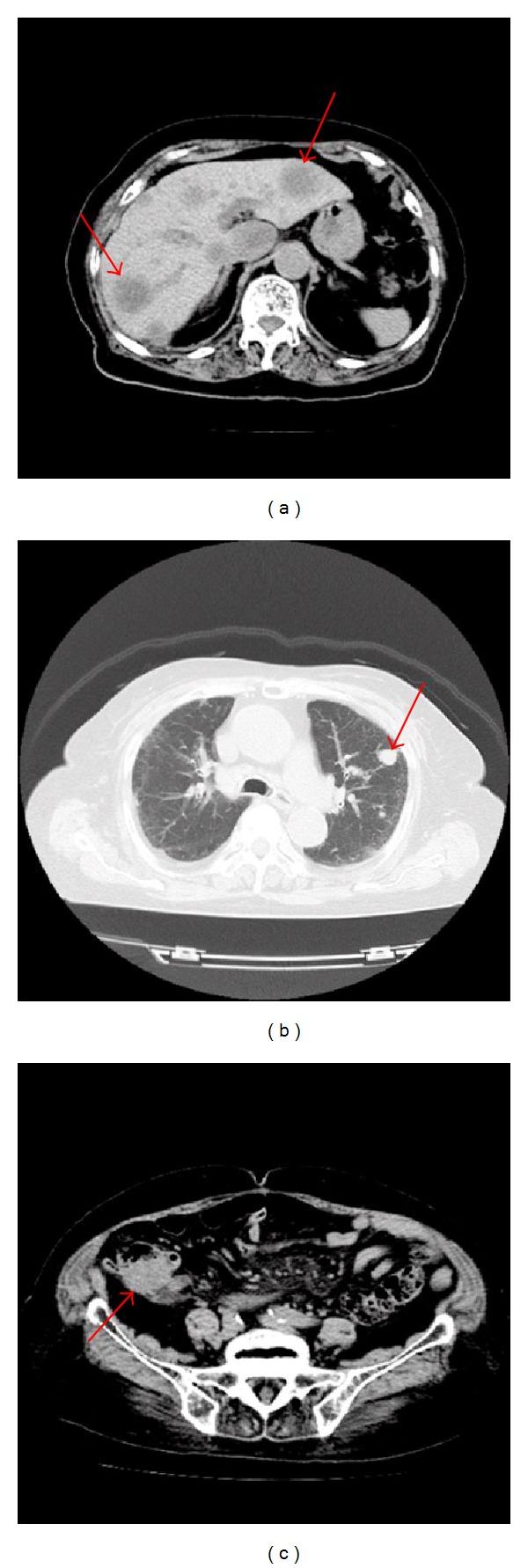 https://cdn.ncbi.nlm.nih.gov/pmc/blobs/397b/3350033/3570281314ef/CRIM.OPHMED2011-972318.002.jpg