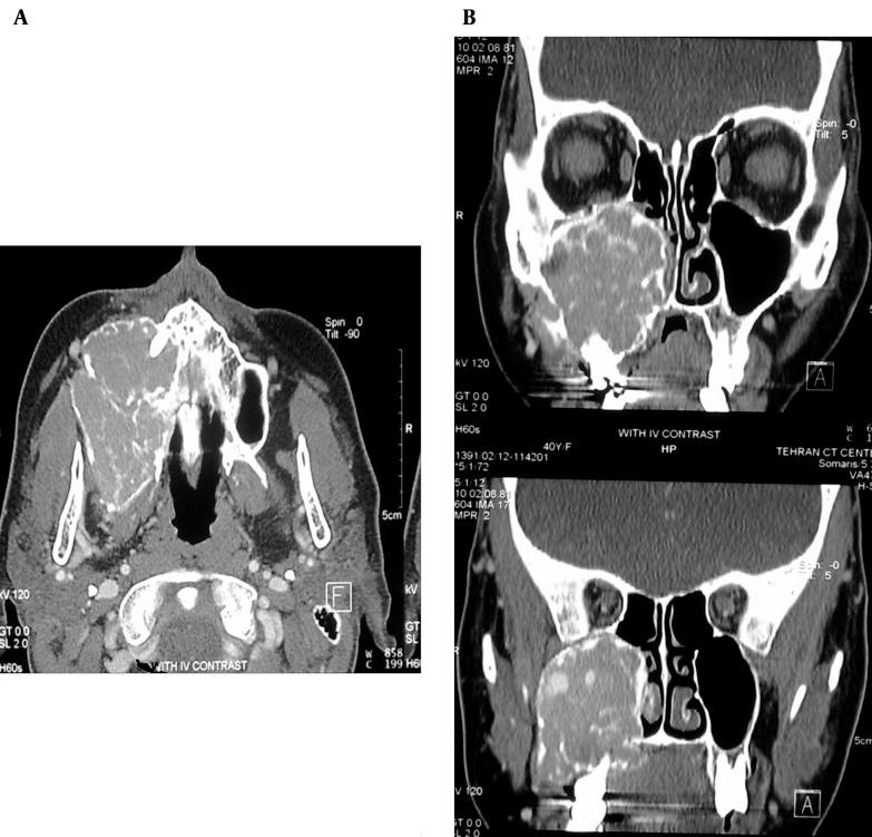 https://cdn.ncbi.nlm.nih.gov/pmc/blobs/3982/4841893/9aa5961c22b2/iranjradiol-13-01-13260-g001.jpg