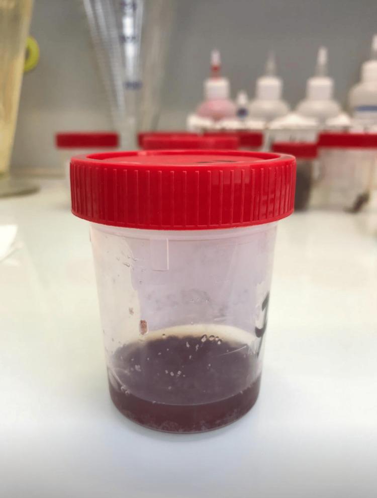 https://cdn.ncbi.nlm.nih.gov/pmc/blobs/3989/12285205/69dbfb21dc6d/cureus-0017-00000086866-i01.jpg