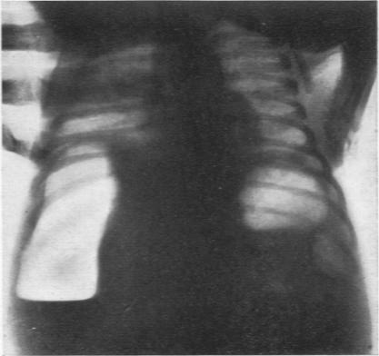 https://cdn.ncbi.nlm.nih.gov/pmc/blobs/3a11/1988473/2d45a05b7fff/archdisch01412-0080-a.jpg