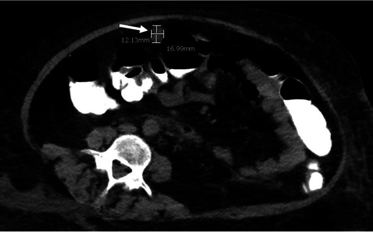https://cdn.ncbi.nlm.nih.gov/pmc/blobs/3a1b/8729312/6be9fc1620b3/cureus-0013-00000020214-i03.jpg