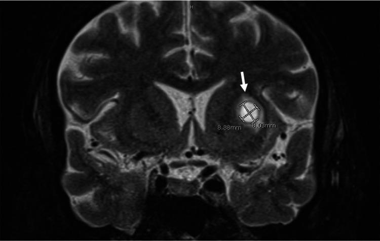 https://cdn.ncbi.nlm.nih.gov/pmc/blobs/3a1b/8729312/ea99b29df897/cureus-0013-00000020214-i02.jpg