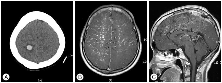 https://cdn.ncbi.nlm.nih.gov/pmc/blobs/3a36/4373050/a20d61693988/jkns-57-204-g001.jpg