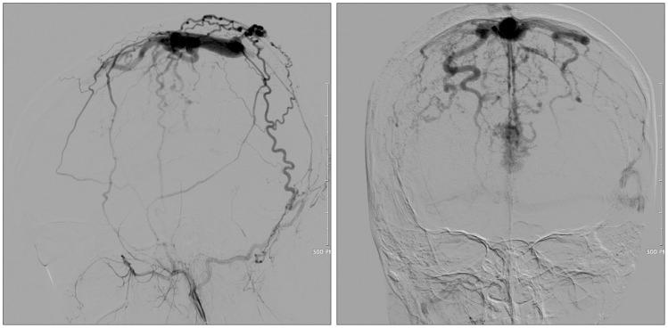 https://cdn.ncbi.nlm.nih.gov/pmc/blobs/3a36/4373050/e81b4c83124d/jkns-57-204-g002.jpg