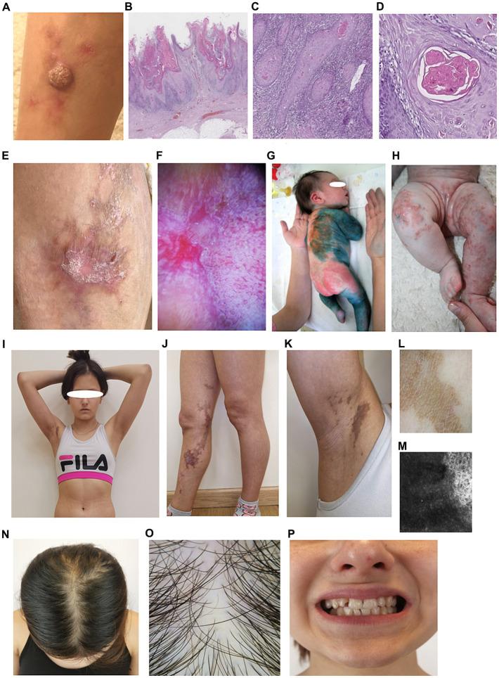 https://cdn.ncbi.nlm.nih.gov/pmc/blobs/3a8b/11288940/41bb63072f72/fmed-11-1402577-g001.jpg