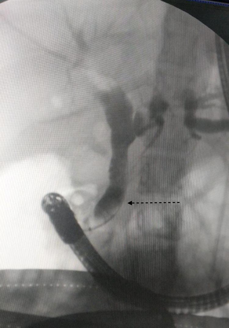https://cdn.ncbi.nlm.nih.gov/pmc/blobs/3aa7/8958046/23bbed9b155b/cureus-0014-00000022610-i06.jpg