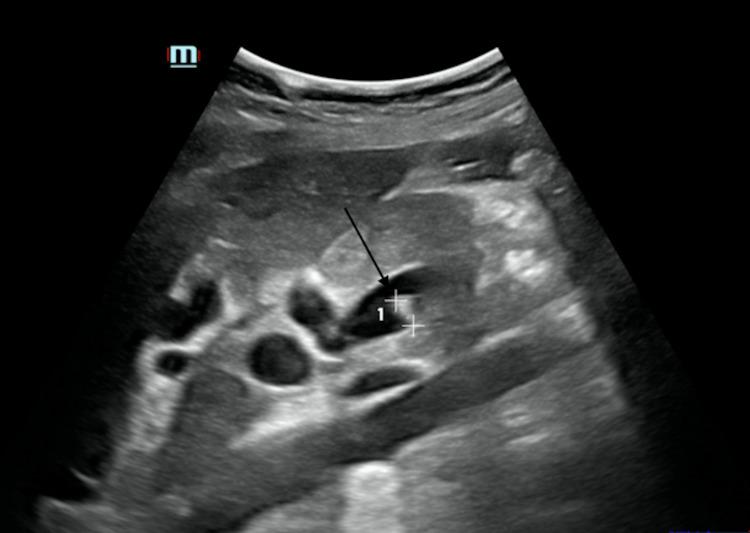 https://cdn.ncbi.nlm.nih.gov/pmc/blobs/3aa7/8958046/d42eb37bc7b1/cureus-0014-00000022610-i02.jpg