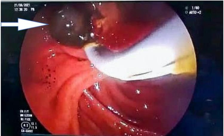 https://cdn.ncbi.nlm.nih.gov/pmc/blobs/3aa7/8958046/d542ed4de218/cureus-0014-00000022610-i05.jpg