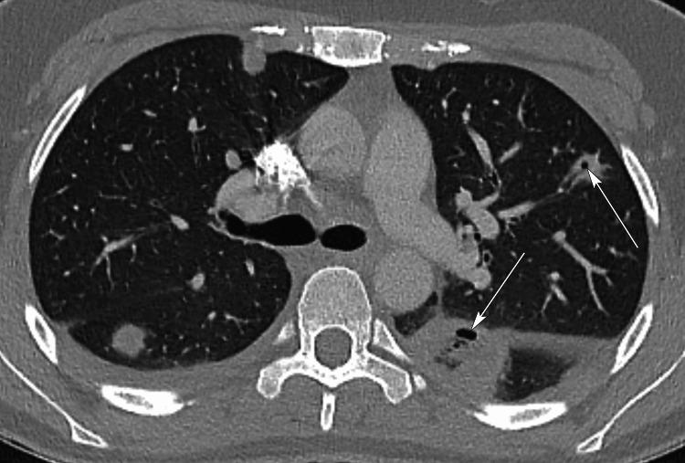 https://cdn.ncbi.nlm.nih.gov/pmc/blobs/3aef/10096120/f043595d7ced/cureus-0015-00000036087-i05.jpg