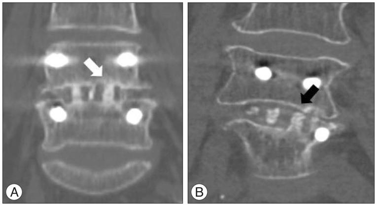 https://cdn.ncbi.nlm.nih.gov/pmc/blobs/3af9/4954884/597f30cafa8a/jkns-59-363-g001.jpg