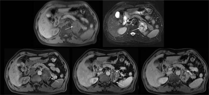 https://cdn.ncbi.nlm.nih.gov/pmc/blobs/3b47/5690763/99739eac372f/medi-96-e8551-g001.jpg