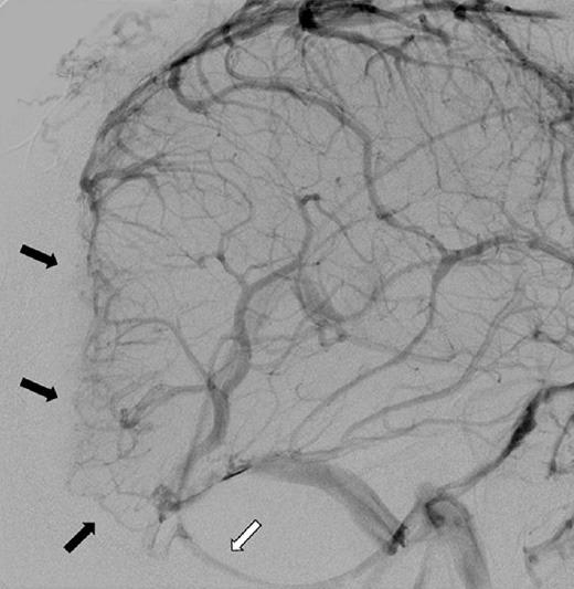 https://cdn.ncbi.nlm.nih.gov/pmc/blobs/3b96/4392537/6192ec5e551e/SNI-6-40-g002.jpg