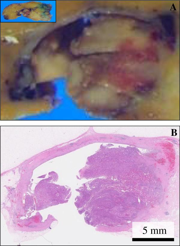https://cdn.ncbi.nlm.nih.gov/pmc/blobs/3bad/3772697/67f50f070a6c/1746-1596-8-75-2.jpg
