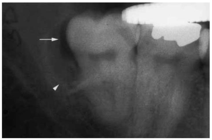 https://cdn.ncbi.nlm.nih.gov/pmc/blobs/3bbd/10742593/791722834c44/dentistry-11-00281-g003.jpg