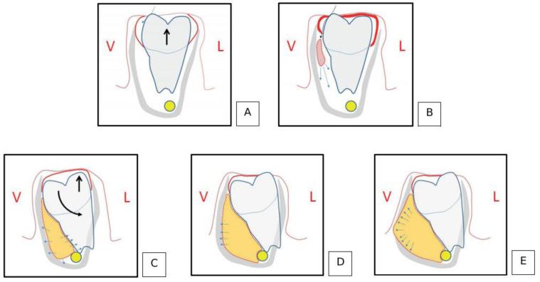 https://cdn.ncbi.nlm.nih.gov/pmc/blobs/3bbd/10742593/e1f83e041cda/dentistry-11-00281-g004.jpg