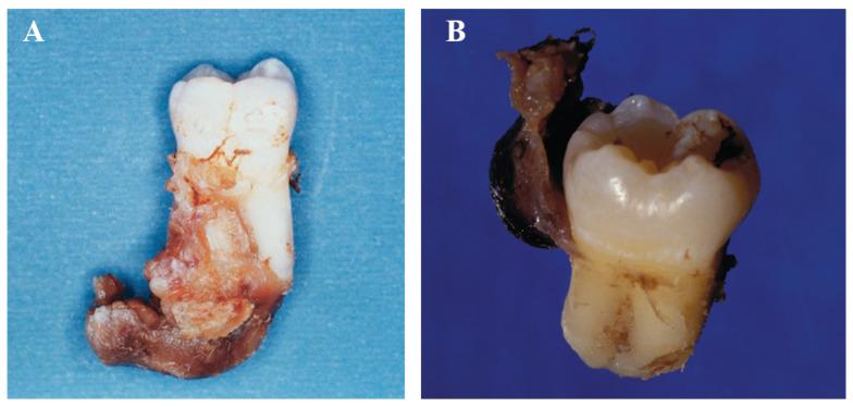 https://cdn.ncbi.nlm.nih.gov/pmc/blobs/3bbd/10742593/e35555a884c3/dentistry-11-00281-g005.jpg