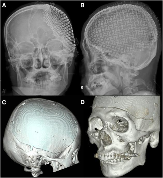 https://cdn.ncbi.nlm.nih.gov/pmc/blobs/3c1a/8592932/321129d631e1/fneur-12-745575-g0003.jpg