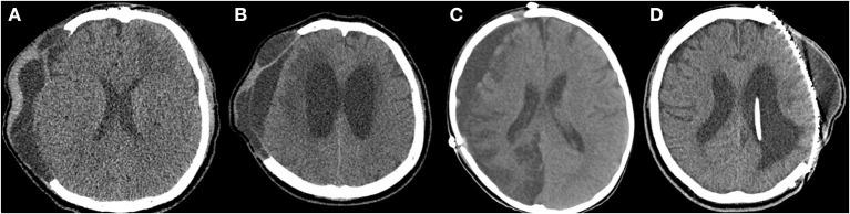 https://cdn.ncbi.nlm.nih.gov/pmc/blobs/3c1a/8592932/4c01d06a05dd/fneur-12-745575-g0001.jpg