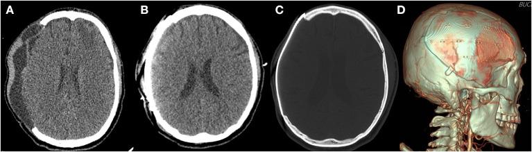 https://cdn.ncbi.nlm.nih.gov/pmc/blobs/3c1a/8592932/734c093e5e36/fneur-12-745575-g0002.jpg