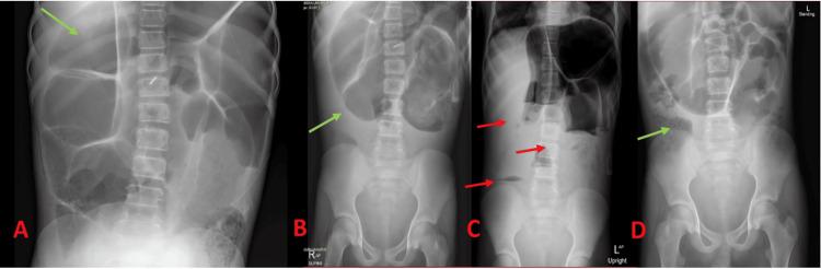 https://cdn.ncbi.nlm.nih.gov/pmc/blobs/3c1d/11977519/061002845365/cureus-0017-00000081886-i05.jpg