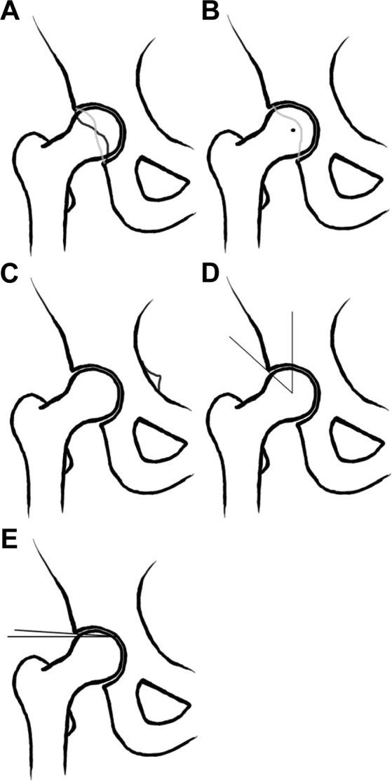 https://cdn.ncbi.nlm.nih.gov/pmc/blobs/3c3b/5455952/014d4026e412/10.1177_2325967117708307-fig2.jpg