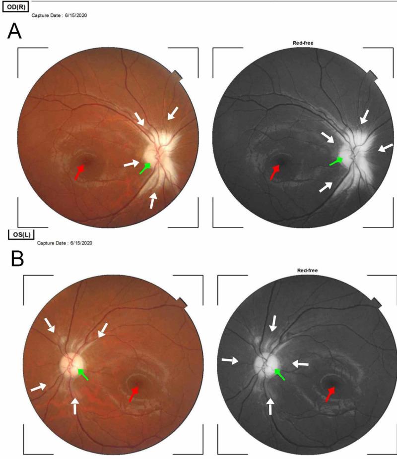 https://cdn.ncbi.nlm.nih.gov/pmc/blobs/3c42/7510502/ef15f1ff6ea7/cureus-0012-00000009960-i01.jpg