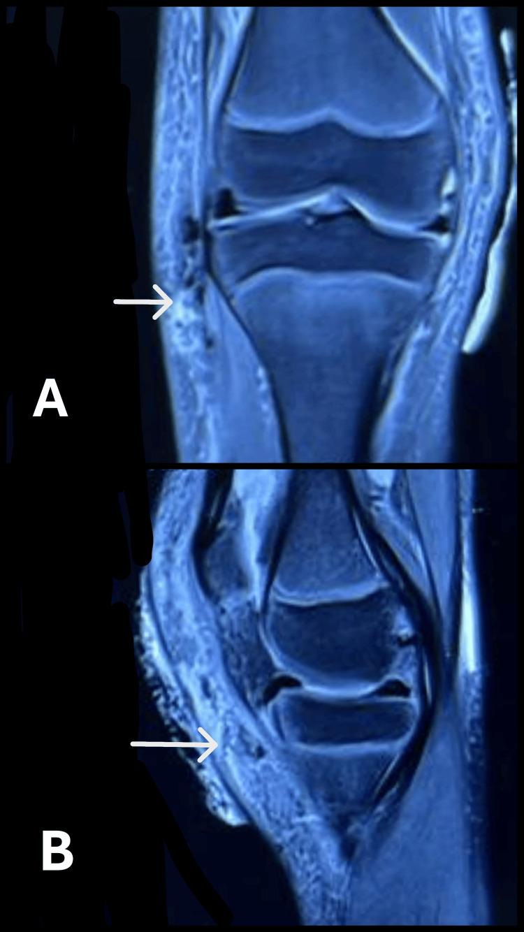 https://cdn.ncbi.nlm.nih.gov/pmc/blobs/3ca4/12431903/aff714cb6671/cureus-0017-00000090008-i02.jpg