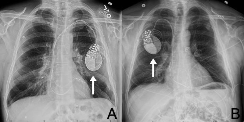 https://cdn.ncbi.nlm.nih.gov/pmc/blobs/3cae/7187994/d1d86b68d69e/cureus-0012-00000007458-i02.jpg