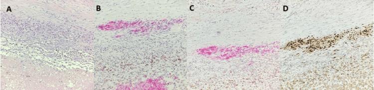 https://cdn.ncbi.nlm.nih.gov/pmc/blobs/3cbd/12382304/65d9d9c526da/cureus-0017-00000088892-i03.jpg