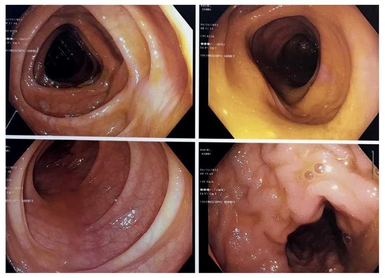 https://cdn.ncbi.nlm.nih.gov/pmc/blobs/3cc8/6364444/7b592f3e60a0/amjcaserep-20-111-g002.jpg