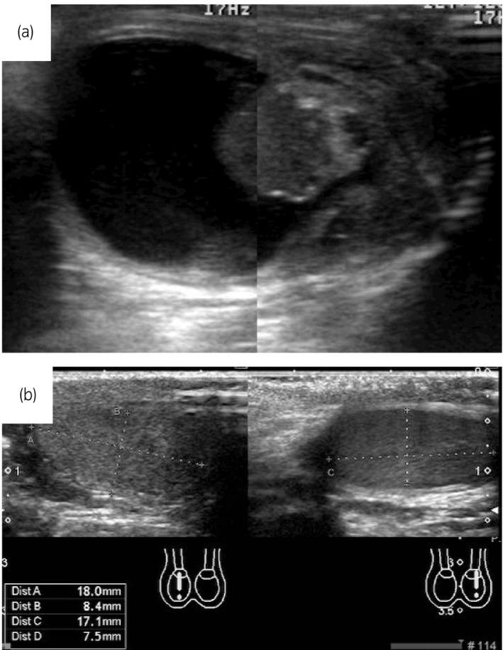https://cdn.ncbi.nlm.nih.gov/pmc/blobs/3cd0/8413212/3400ba32ada2/IJU5-4-289-g002.jpg
