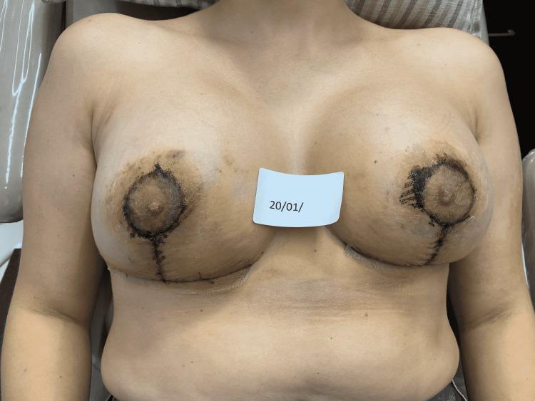 https://cdn.ncbi.nlm.nih.gov/pmc/blobs/3d45/9167639/017d074f1db8/cureus-0014-00000025666-i10.jpg