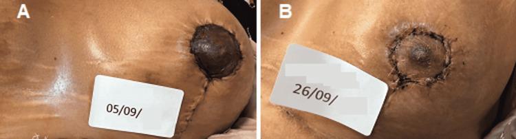 https://cdn.ncbi.nlm.nih.gov/pmc/blobs/3d45/9167639/73dd9a39f3ca/cureus-0014-00000025666-i05.jpg