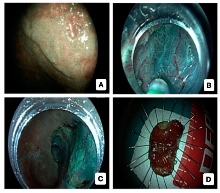 https://cdn.ncbi.nlm.nih.gov/pmc/blobs/3d95/10795709/53b20efdf291/diagnostics-14-00009-g002.jpg