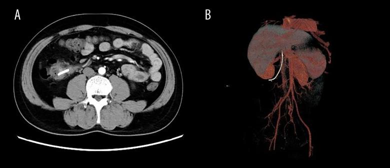 https://cdn.ncbi.nlm.nih.gov/pmc/blobs/3dc9/10926232/1e05bb80d926/amjcaserep-25-e943020-g001.jpg