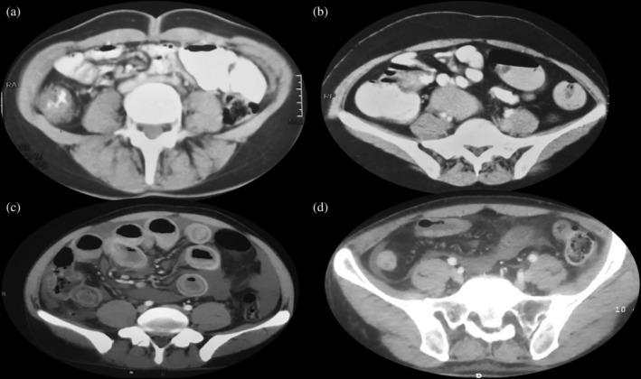 https://cdn.ncbi.nlm.nih.gov/pmc/blobs/3ddb/6891021/2131057af894/JGH3-3-456-g001.jpg