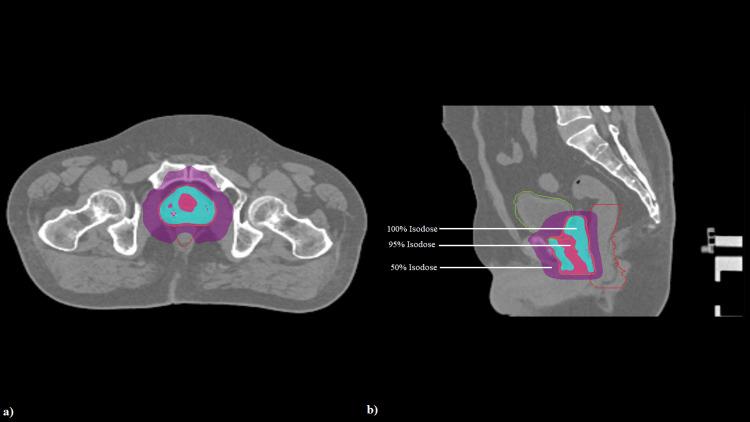https://cdn.ncbi.nlm.nih.gov/pmc/blobs/3e44/12145168/4ea50e7adc24/cureus-0017-00000083742-i02.jpg