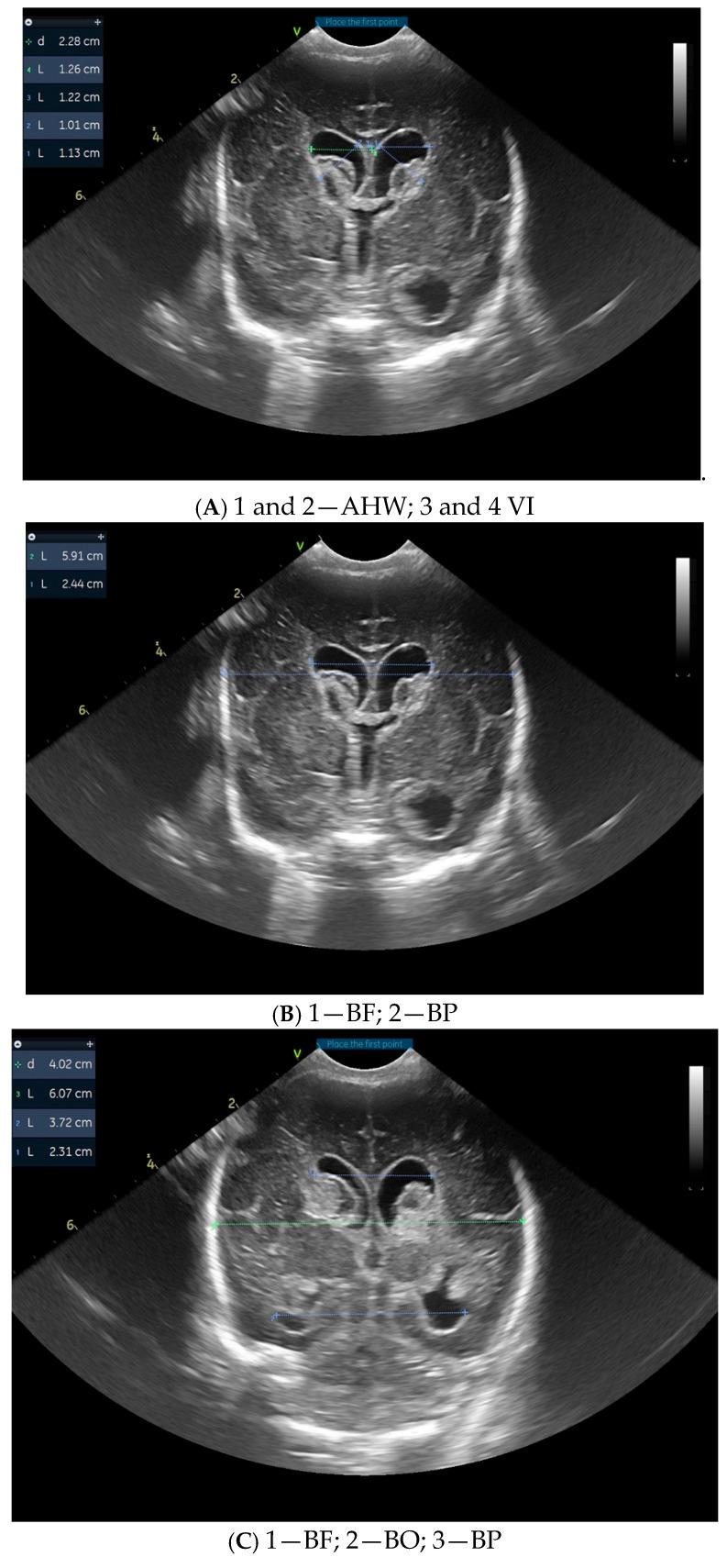 https://cdn.ncbi.nlm.nih.gov/pmc/blobs/3e5f/12191494/dc6c7488f383/children-12-00768-g001a.jpg