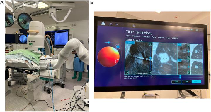 https://cdn.ncbi.nlm.nih.gov/pmc/blobs/3eca/12172655/753a35b97491/fsurg-12-1566902-g002.jpg