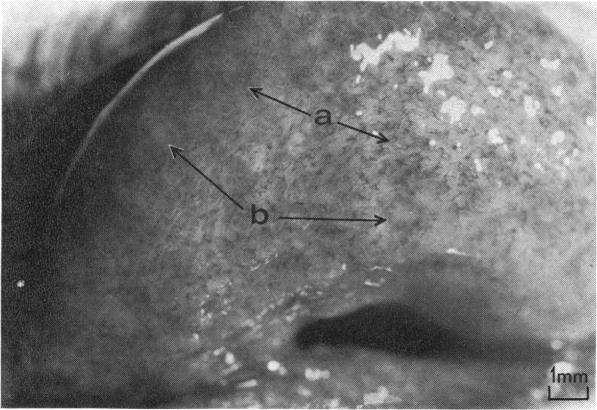 https://cdn.ncbi.nlm.nih.gov/pmc/blobs/3eeb/1042885/4321c33e59d5/brjopthal00230-0010-b.jpg