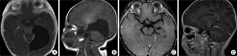 https://cdn.ncbi.nlm.nih.gov/pmc/blobs/3f14/3488640/609d5872b697/jkns-52-325-g002.jpg