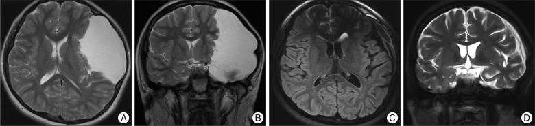 https://cdn.ncbi.nlm.nih.gov/pmc/blobs/3f14/3488640/9e76d7317143/jkns-52-325-g001.jpg