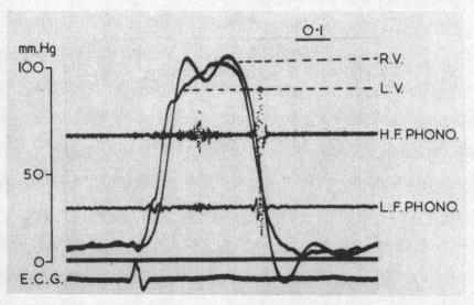 https://cdn.ncbi.nlm.nih.gov/pmc/blobs/3f52/503299/327f02bf04ab/brheartj00337-0046-b.jpg