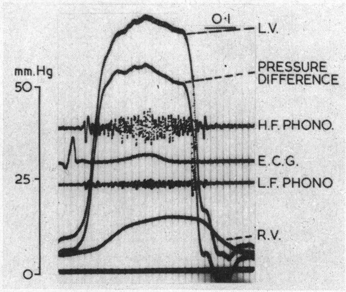 https://cdn.ncbi.nlm.nih.gov/pmc/blobs/3f52/503299/d63f7f771a66/brheartj00337-0045-b.jpg