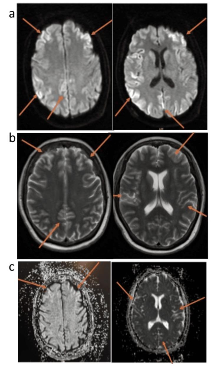 https://cdn.ncbi.nlm.nih.gov/pmc/blobs/3f63/11576066/8672c7c3bc64/cureus-0016-00000073928-i01.jpg