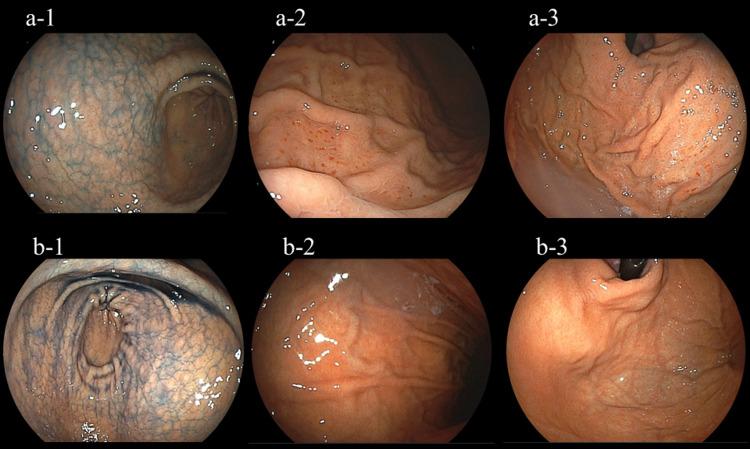 https://cdn.ncbi.nlm.nih.gov/pmc/blobs/3fa3/8279802/a2709bc48ae8/cureus-0013-00000015651-i03.jpg