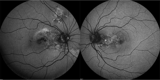 https://cdn.ncbi.nlm.nih.gov/pmc/blobs/3fc7/10385706/2a6915536c09/RomJOphthalmol-67-185-g003.jpg