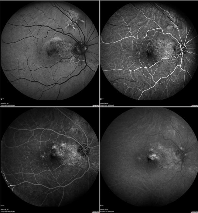 https://cdn.ncbi.nlm.nih.gov/pmc/blobs/3fc7/10385706/7e25afc35727/RomJOphthalmol-67-185-g004.jpg