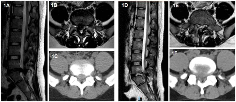 https://cdn.ncbi.nlm.nih.gov/pmc/blobs/3fe5/12213425/8891158f8bd9/fneur-16-1551742-g001.jpg