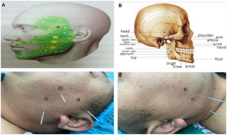 https://cdn.ncbi.nlm.nih.gov/pmc/blobs/3ff6/11231956/3ff51d4c5537/fneur-15-1408360-g001.jpg